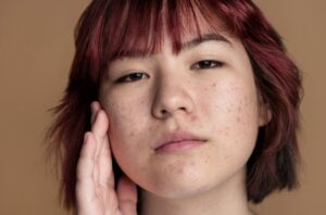 Cara Menghilangkan Bruntusan