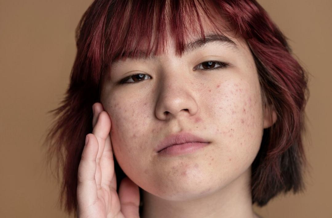 Cara Menghilangkan Bruntusan